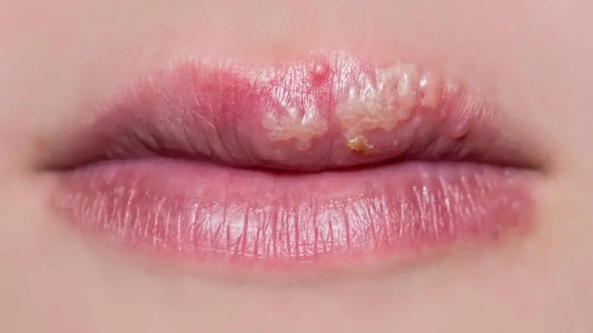 What Is A Cold Sore? Here's What Causes It