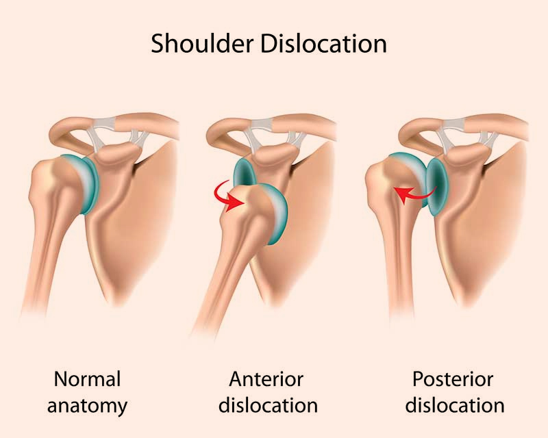 Dislocated Shoulder