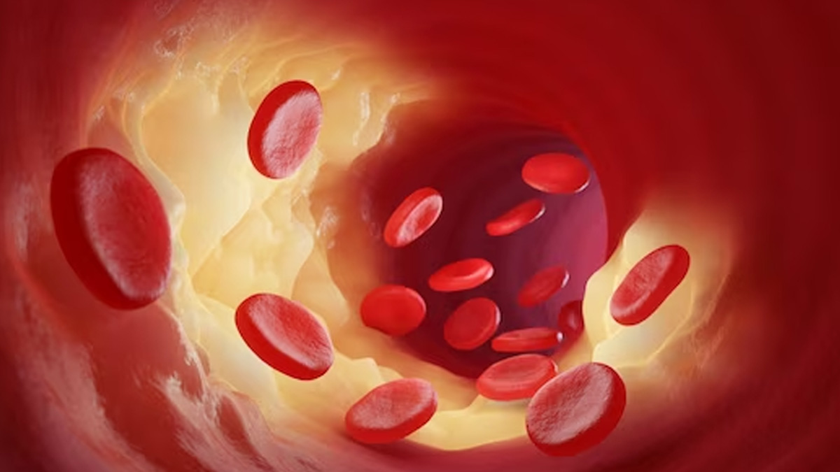 What is Haemophilia A? Causes, Signs, Treatment
