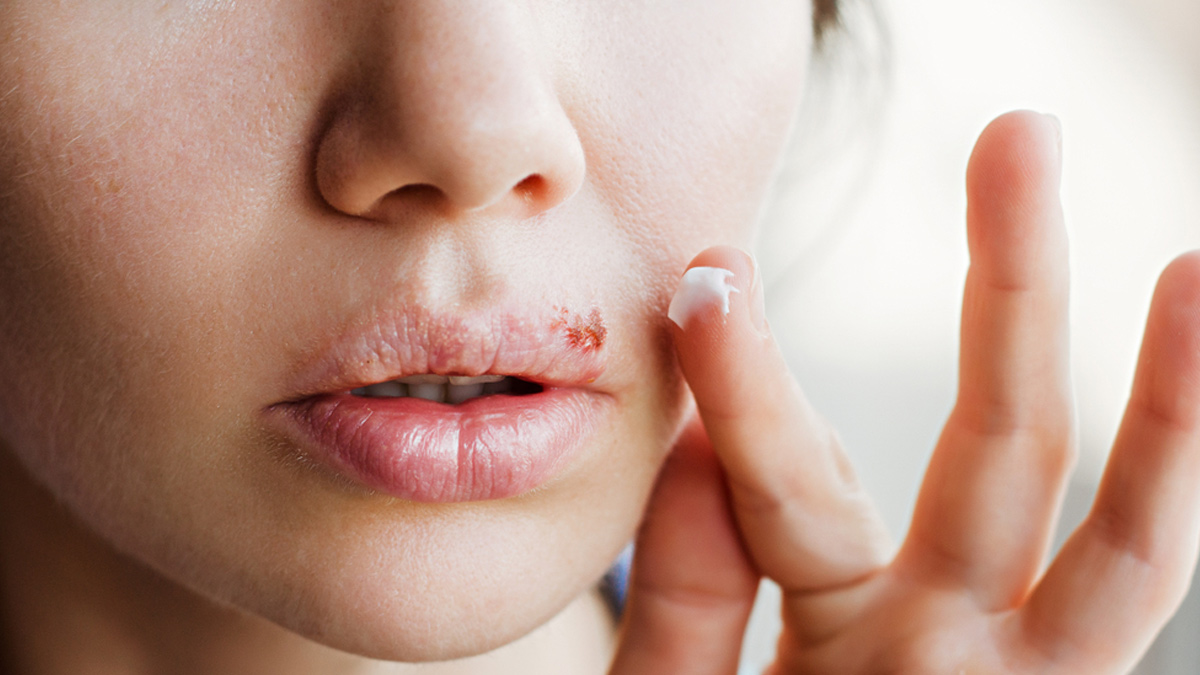 What Is A Cold Sore? Here's What Causes It