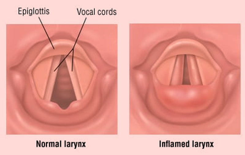Laryngitis