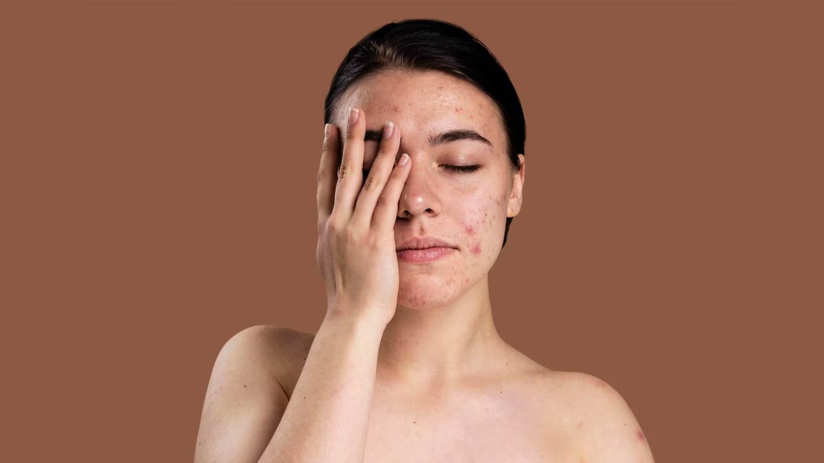 Connection Between OverThinking And Skin Issues in Hindi