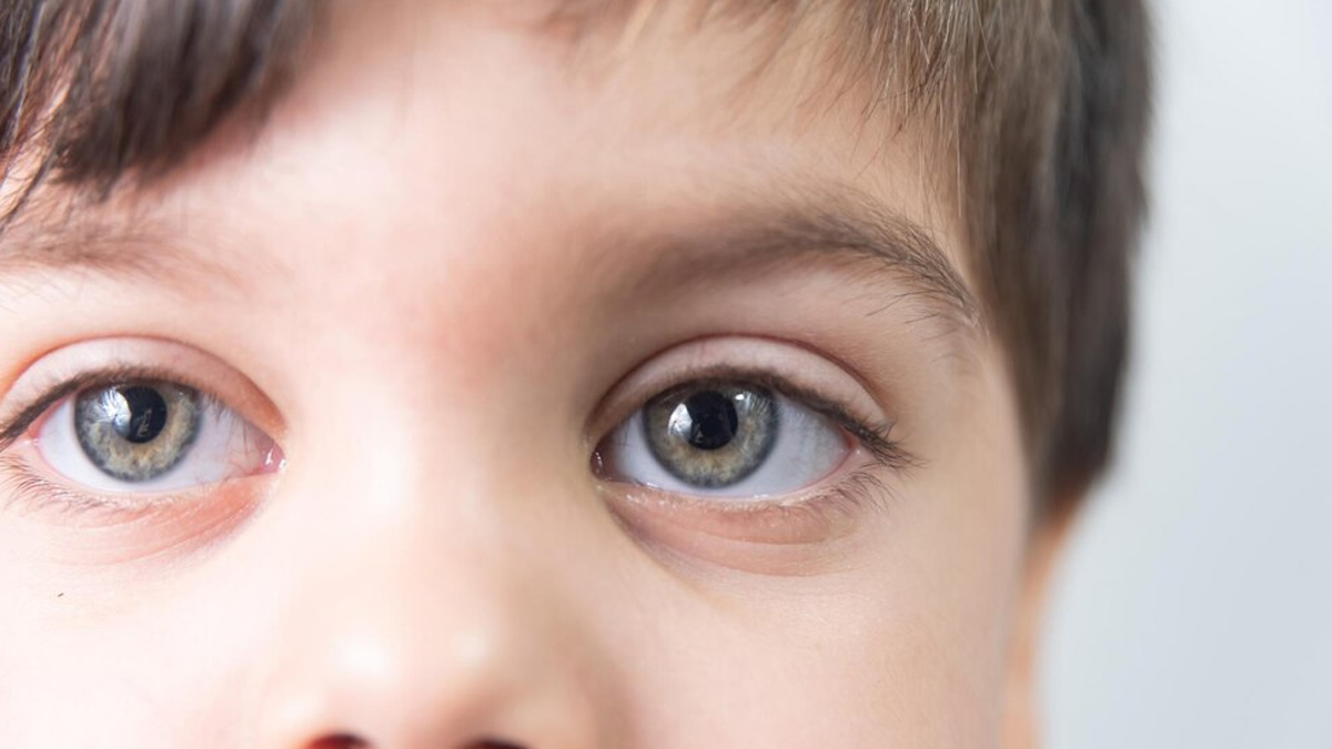 Is It Normal For Babies To Have Cataracts In Hindi