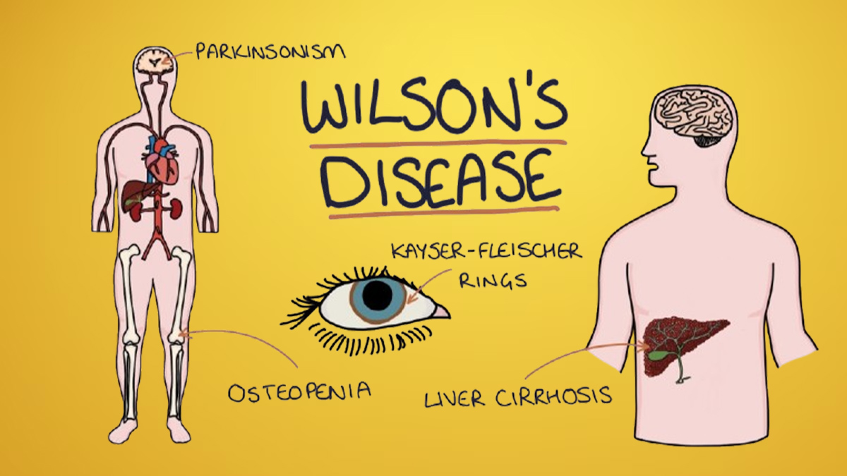 wilson disease in hindi