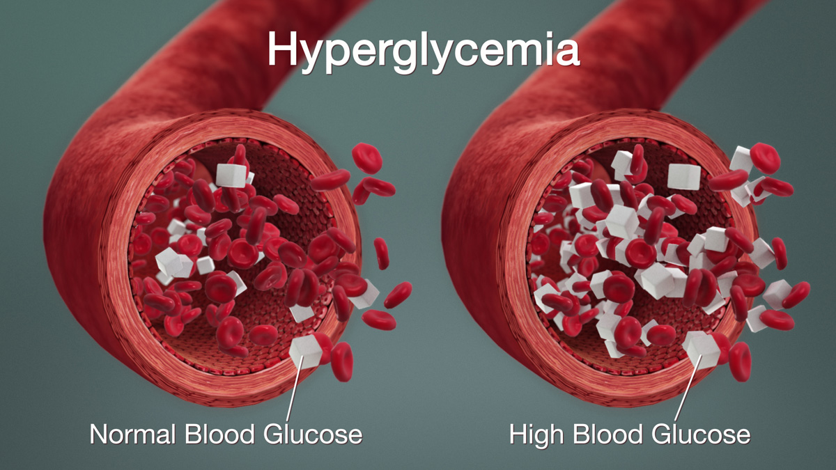Hyperglycemia