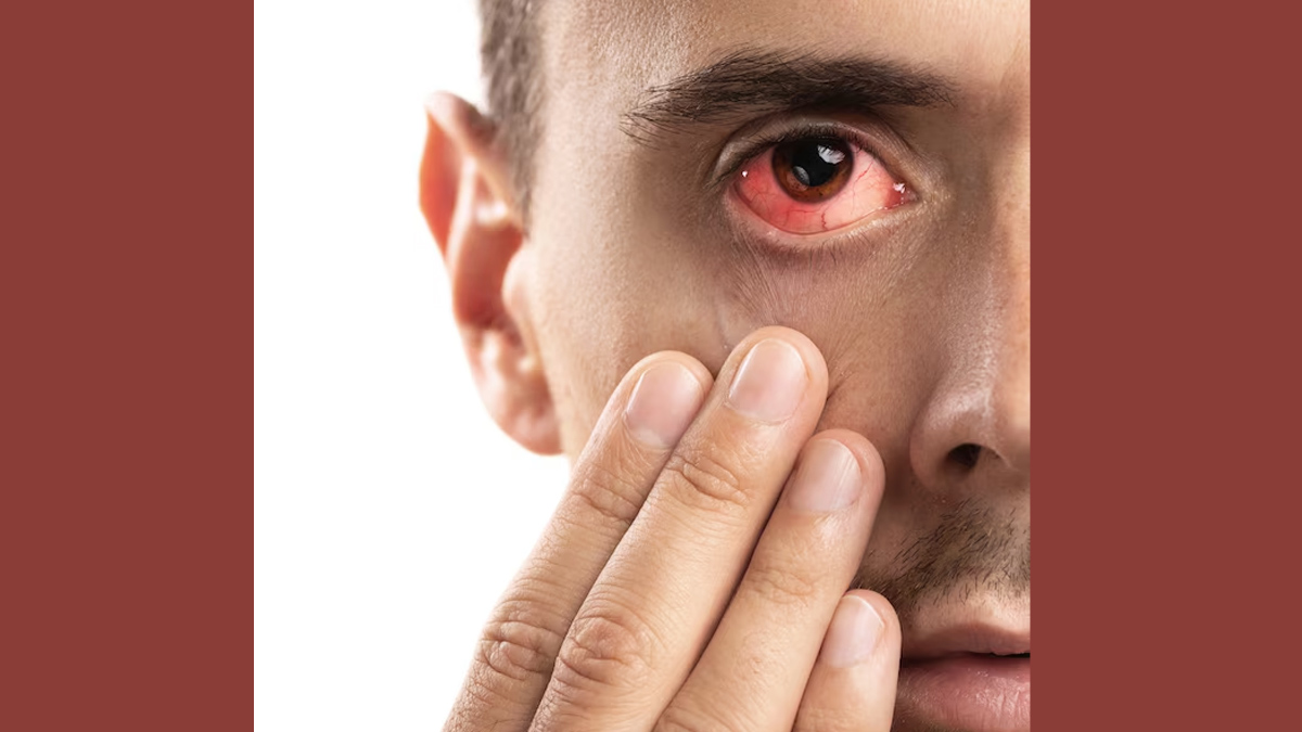 Common Causes Of Epiphora In Hindi