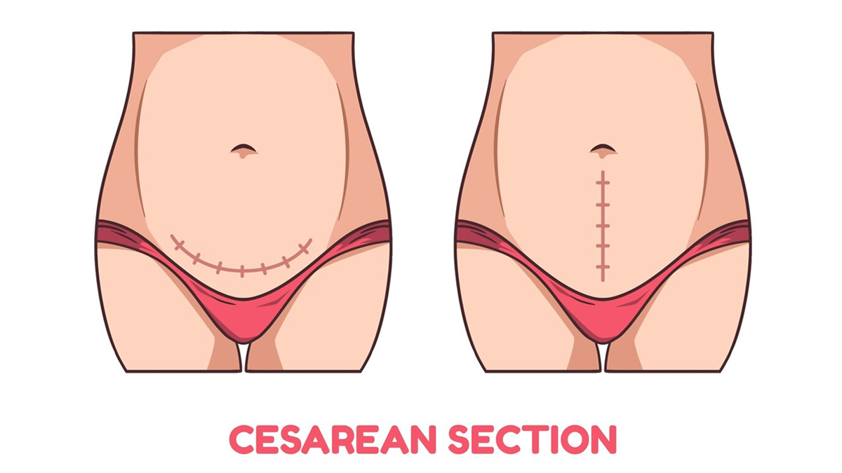 Is It Okay To Have Irregular Periods After C-Section In Hindi