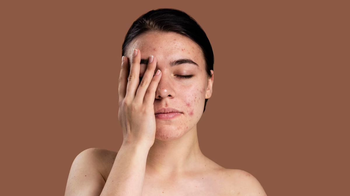 side effects of sunburn acne in hidi