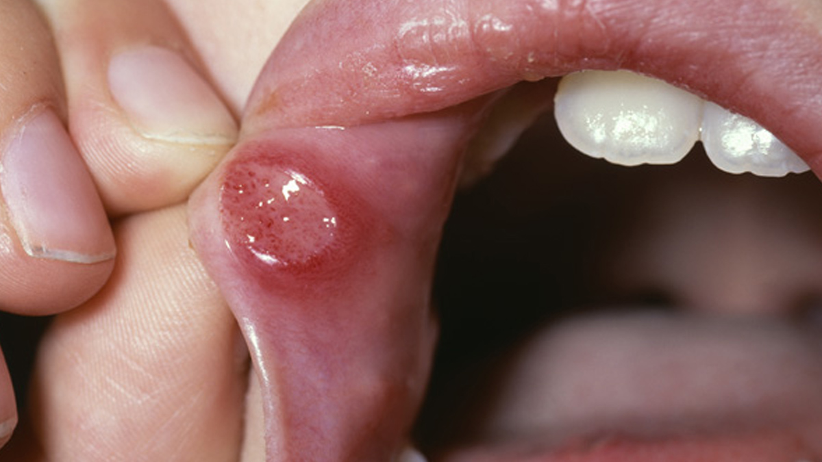 mucositis