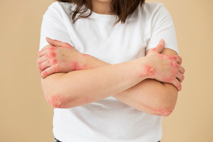 eczema