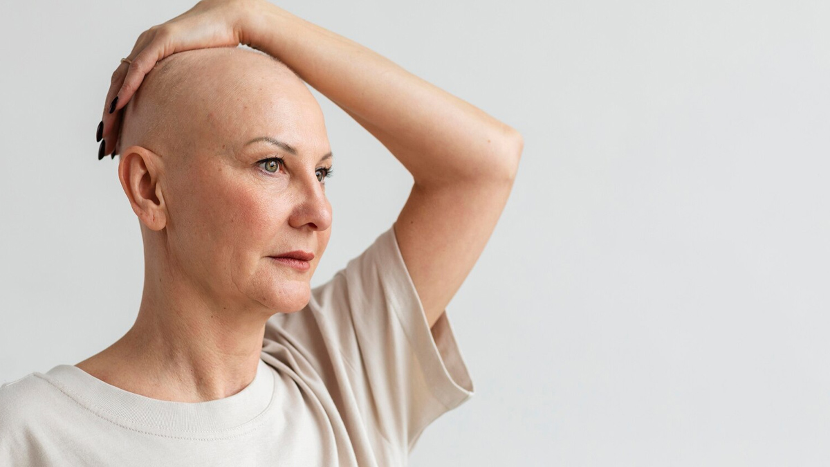 Alopecia Universalis