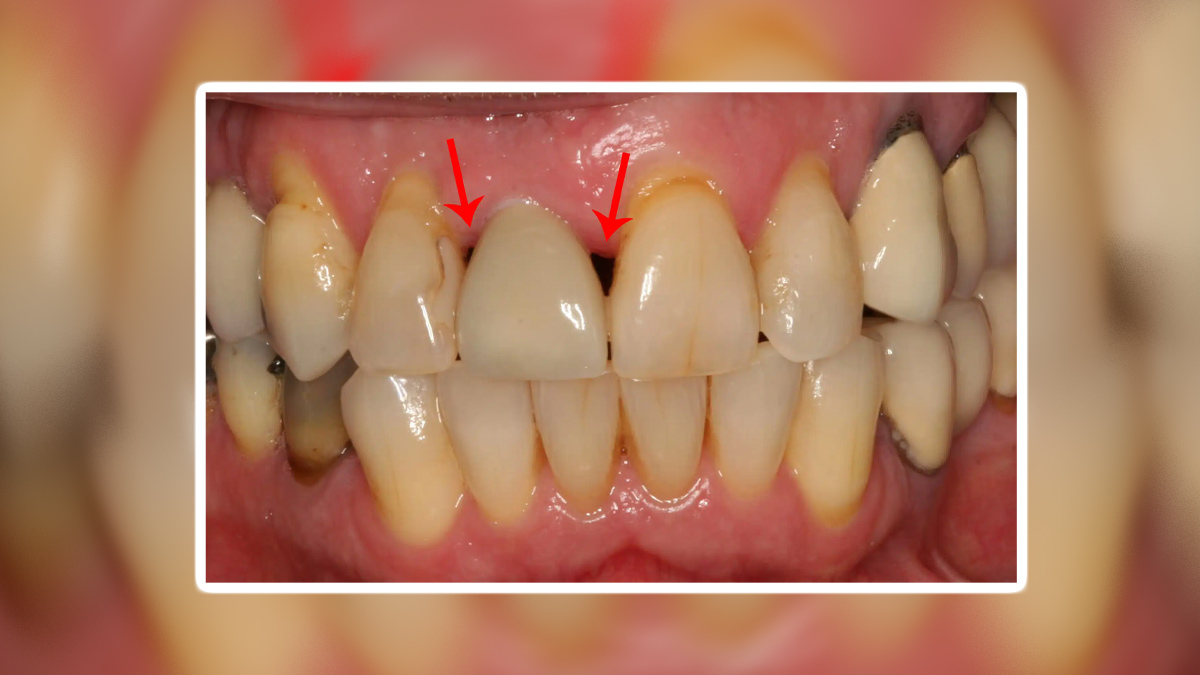 black triangle between teeth