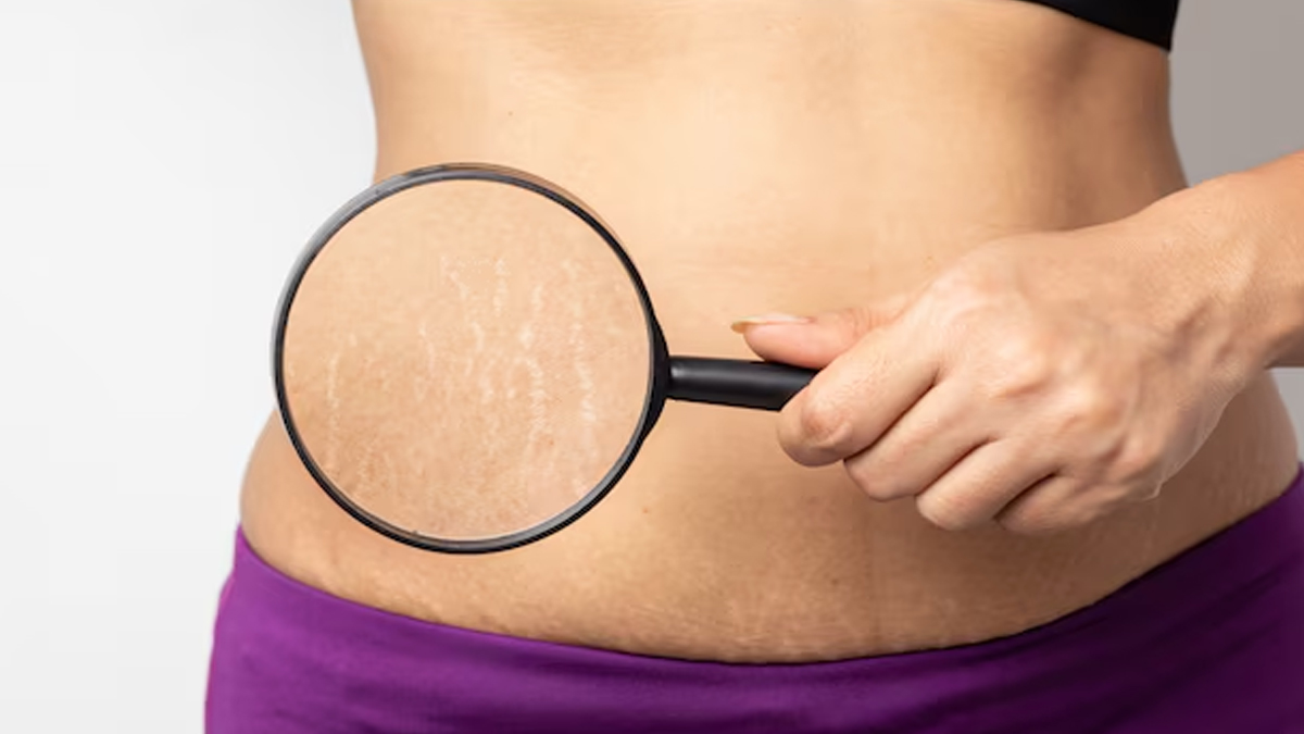 strecth-marks-pregnancy