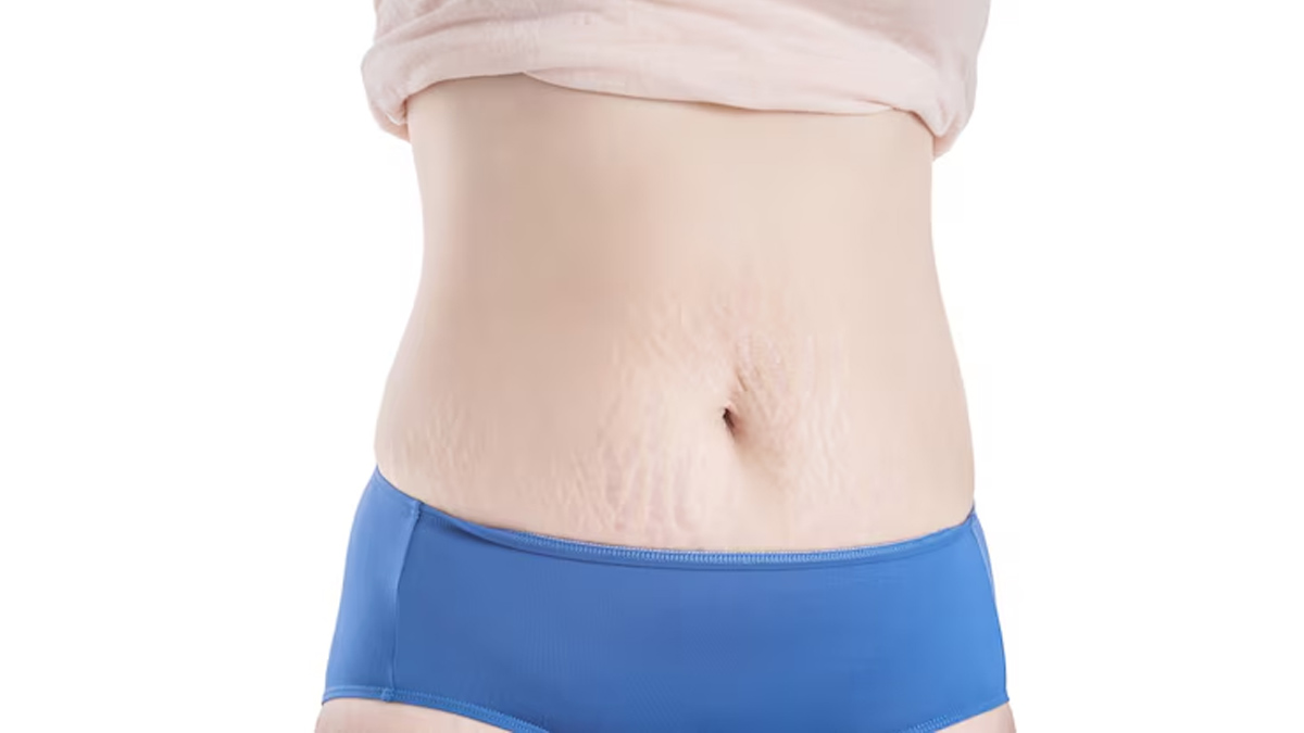 How To Prevent Stretch Marks During Weight Loss In Hindi