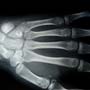 Prognosis of Bone Cancer