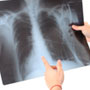 What are the Risk Factors for Tuberculosis?