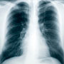How Tuberculosis Spreads