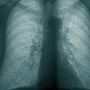 New Tactics in the Fight against Tuberculosis