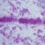 10 Facts about Tuberculosis