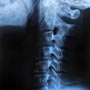 How is Bone Cancer diagnosed?