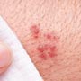 How can one Prevent Genital Warts?