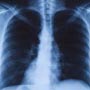 Causes of Lung Disease