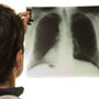 November is observed as Lung Cancer Awareness Month