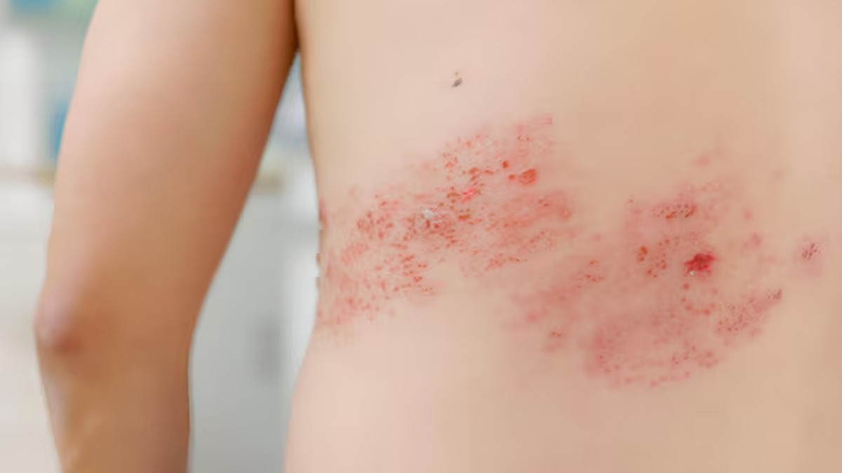 Shingles Awareness Week Expert Explains Why Shingles Is More Than Just