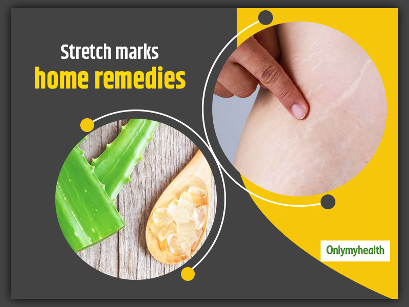 Try These 10 Impressive Home Remedies To Reduce Stretch Marks Naturally