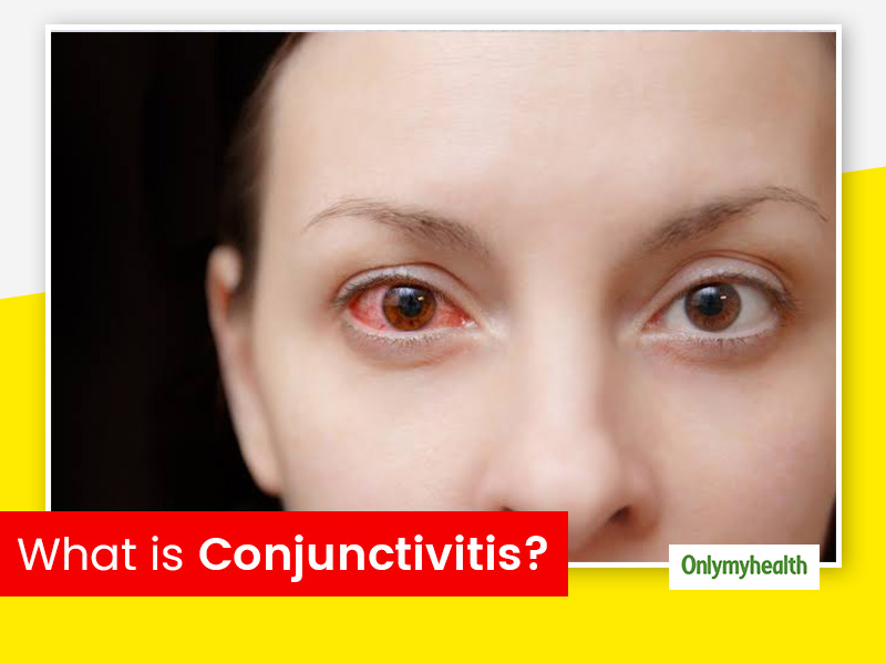 What Is Conjunctivitis? Opthalmologist Talks About Symptoms, Causes and Treatment Options