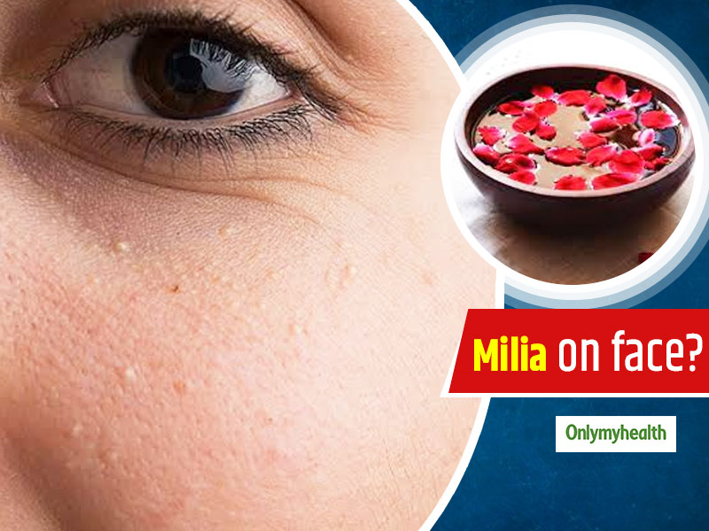 Having Milia On Your Face? Here Are 10 Useful Home Remedies To Get Rid Of Them