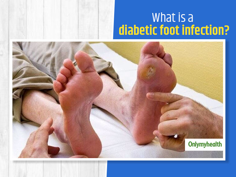 Diabetic Foot Symptoms & Signs You Should Know