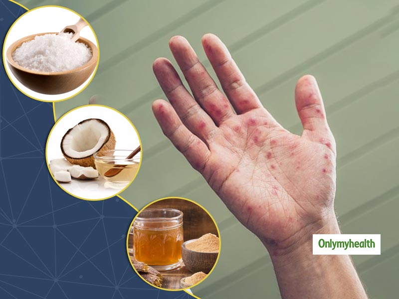 Stay Safe From Hand, Foot and Mouth Disease With These 5 Simple Remedies