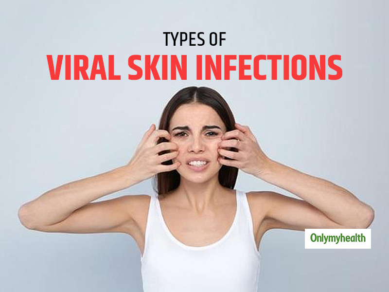 viral skin infections