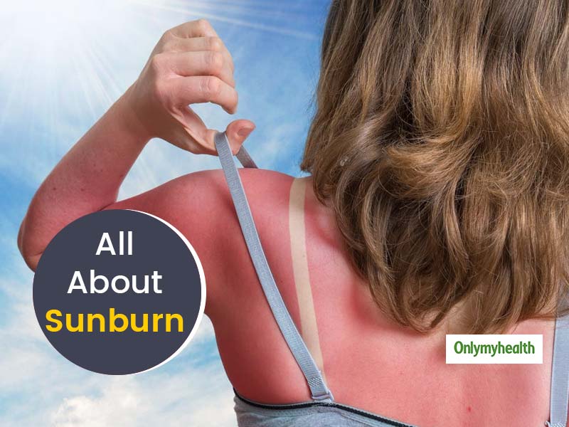 Sunburns: Symptoms, Causes, Risk Factors, Treatment and Prevention