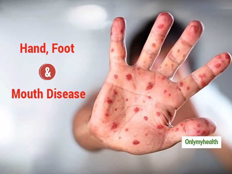 Hand, Foot And Mouth Disease: Symptoms, Causes And Care Tips