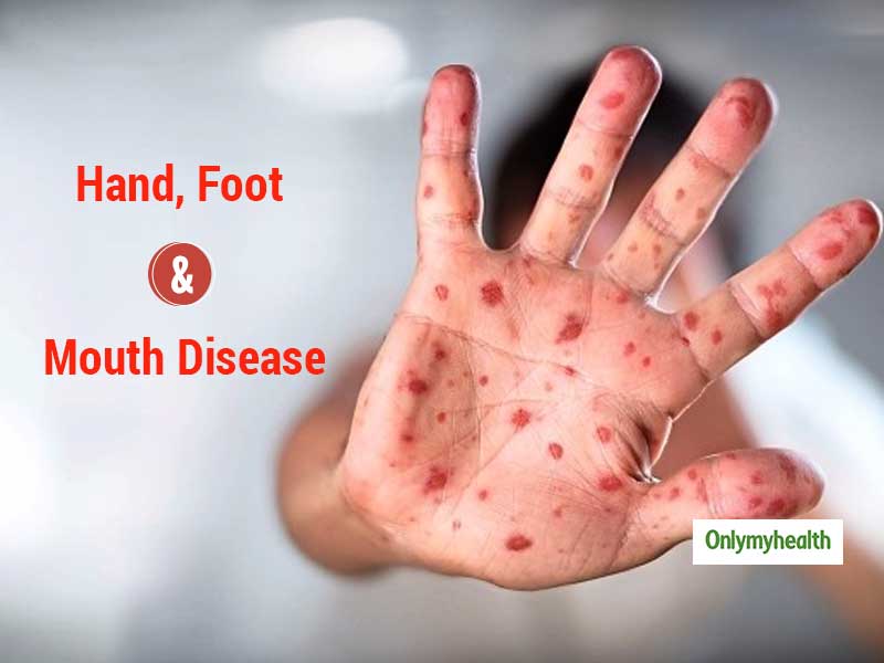 Hand Foot And Mouth Disease Symptoms