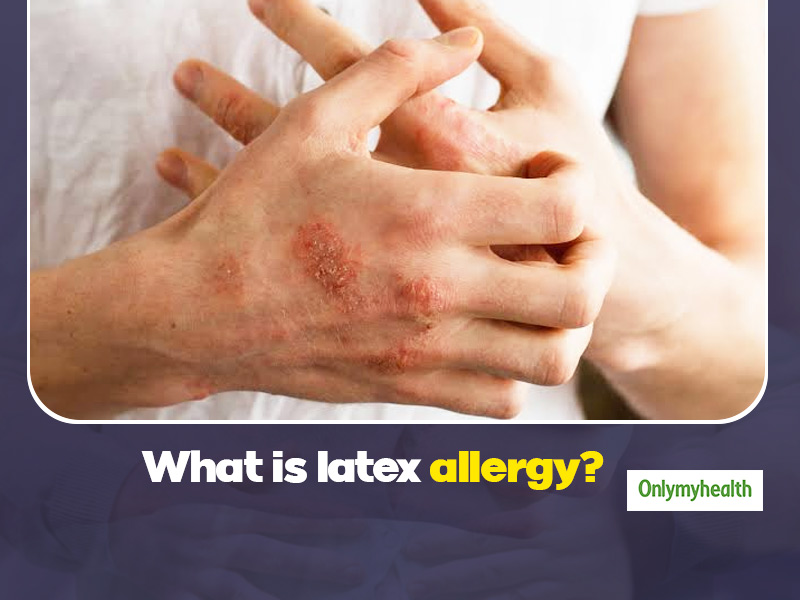 LATEX ALLERGY