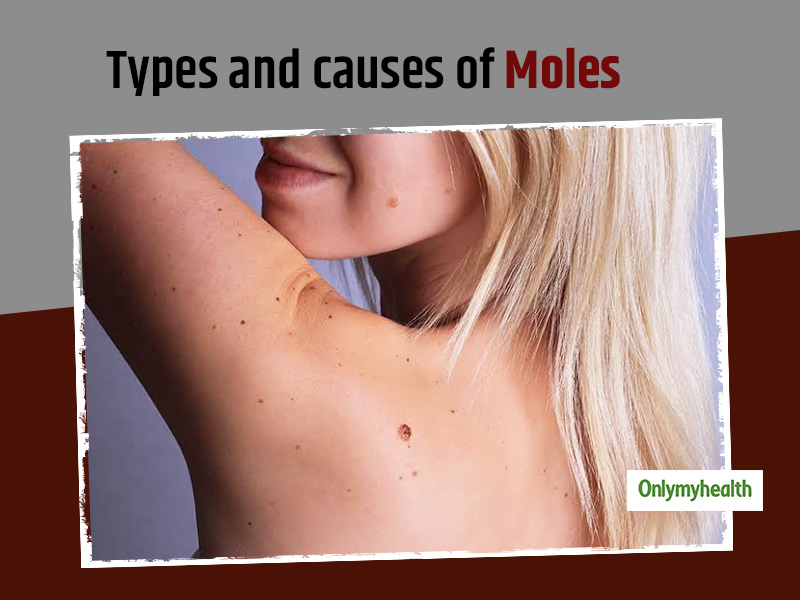  Want To Know The Types And Causes Of A Mole? Dr Sukriti Sharma Talks About It