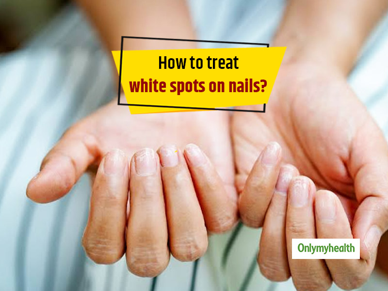 Why Do White Spots Develop On Our Nails? Here's How You Can Treat Them