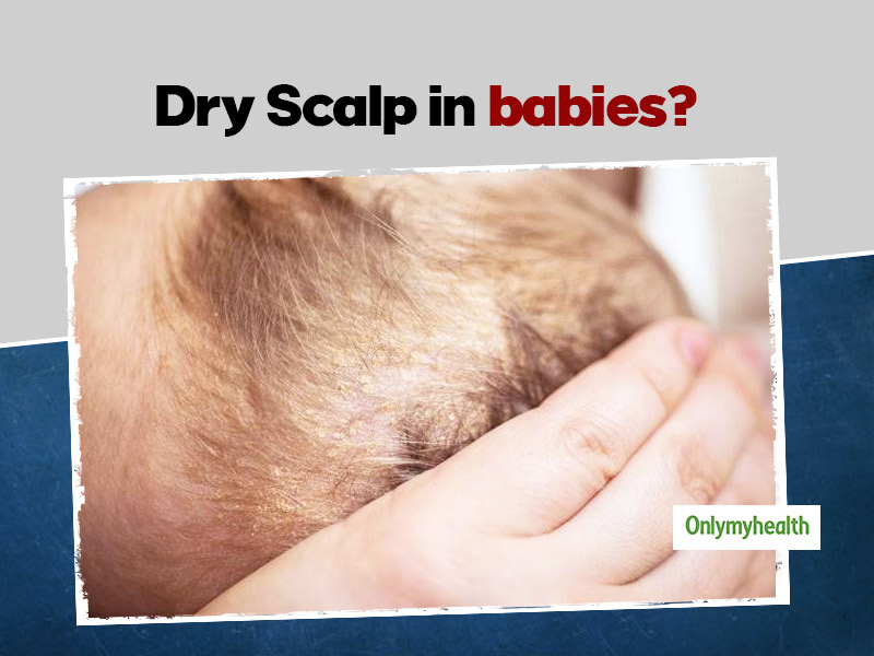 Dry Scalp In Babies: Symptoms, Causes and Ways To Treat At Home