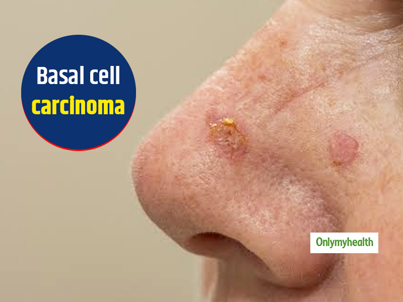  Basal Cell Carcinoma: Symptoms, Causes And Treatment By Oncologist Dr Ashok Vaid