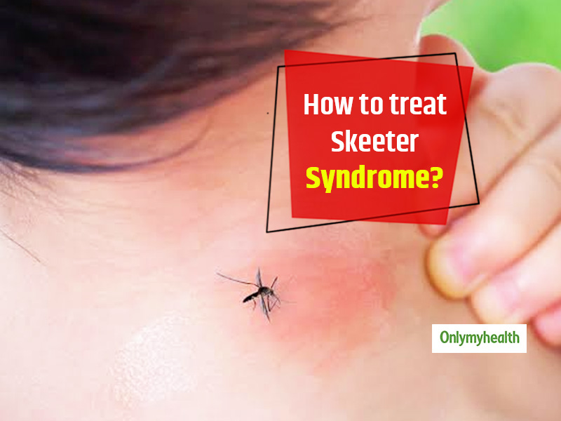 Skeeter Syndrome Home Remedies And Tips To Prevent This Allergic Reaction