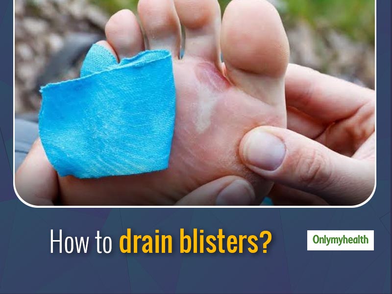 Want To Know How To Drain Blisters? Here's A Full Guide Of When, Why And How To Pop It