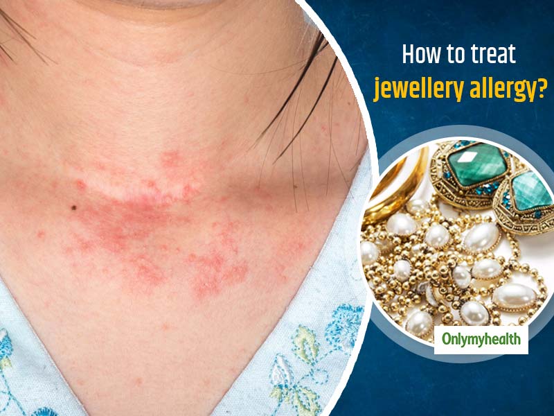 How to treat allergic reaction to necklace