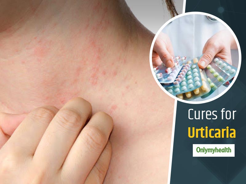 Here's Everything You Need To Know About Urticaria, Symptoms, Causes And  Treatment