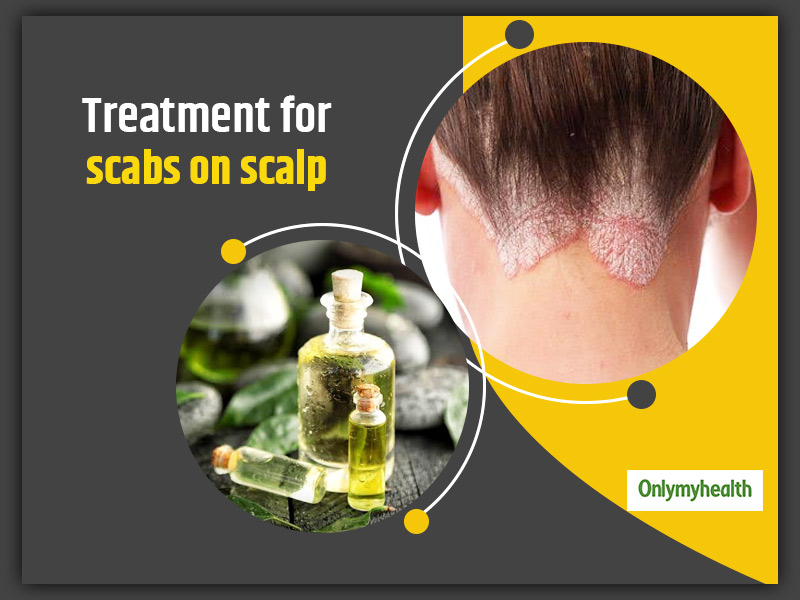 Experiencing Scabs On Scalp? Check Out These Symptoms, Causes And Natural Treatment