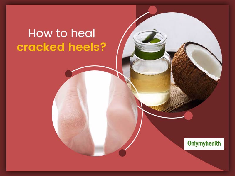 How to Heal Deep Cracked Heels - My Mommy Style