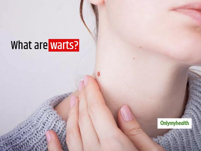 Warts: Symptoms, Causes And Treatment