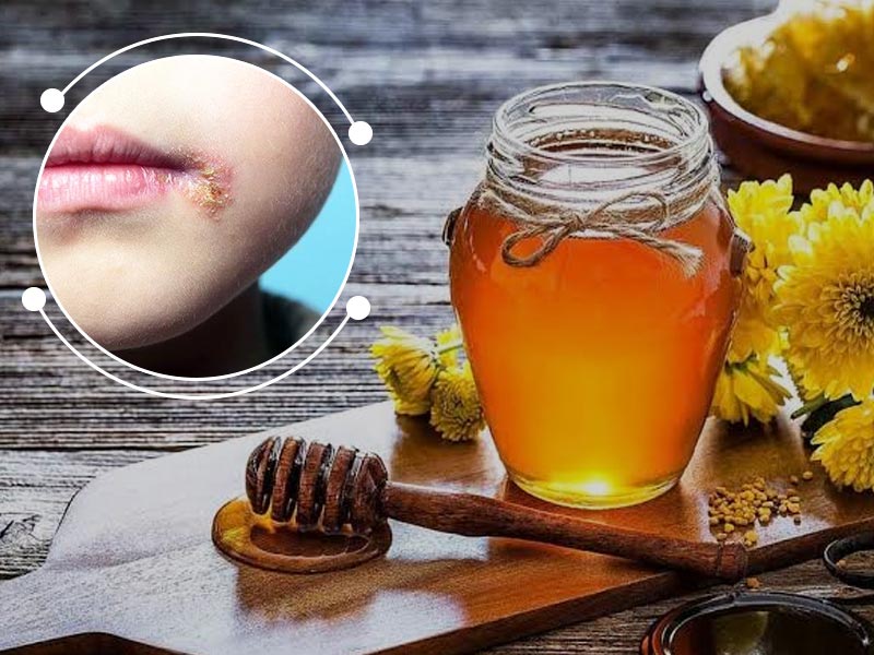 Want Relief From The Symptoms Of Herpes? Try These 7 Effective Natural Remedies 
